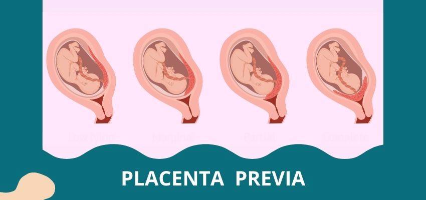 placenta previa low lying placenta